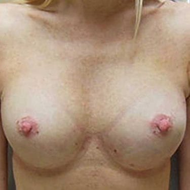 Breast Reconstruction (Bilateral Mastectomies) - After 1