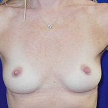 Breast Reconstruction (Bilateral Mastectomies) - Before 1