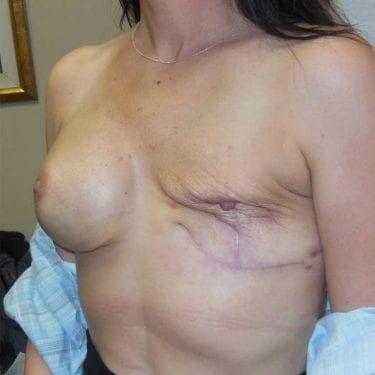 Breast Reconstruction Revision (Bilateral Mastectomies) - Before 2