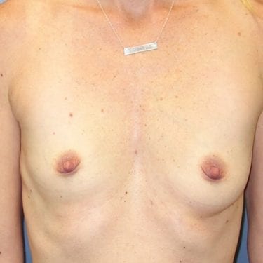Breast Augmentation Patient 03 - Before 1
