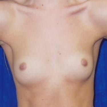 Breast Augmentation Patient 05 - Before 1