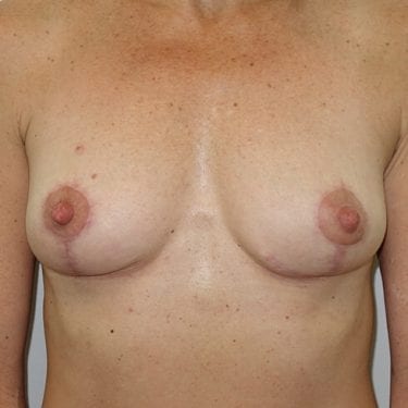 Breast Lift Patient 03 - After 1