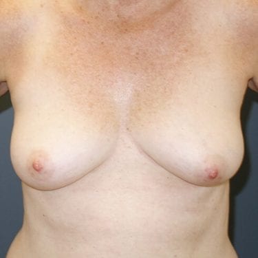 Breast Reconstruction Patient 16 - Before 1