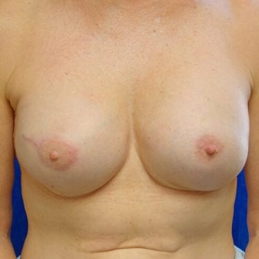 Breast Reconstruction Patient 09 - After 1