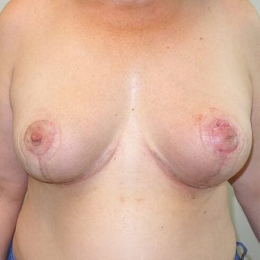 Breast Reduction Patient 02 - After 1