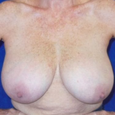 Breast Reduction Patient 04 - Before 1