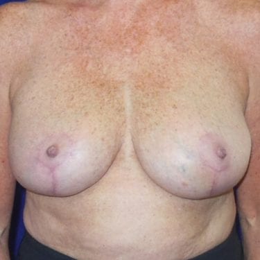 Breast Reduction Patient 04 - After 1