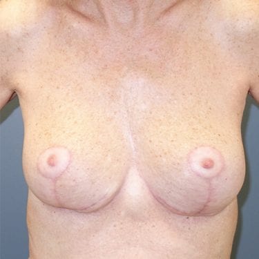 Breast Reduction Patient 07 - After 1