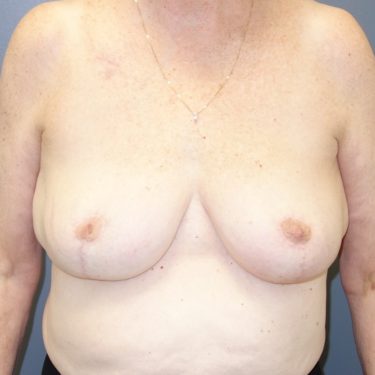 Breast Reconstruction Patient 17 - After 1
