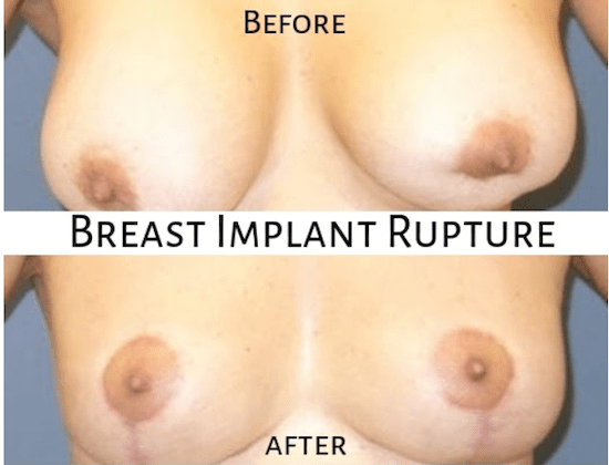 Before and after image showing implant rupture.