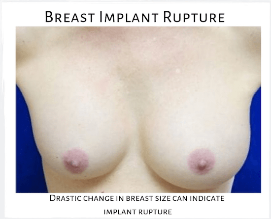 Patient who has experienced breast implant rupture on right breast.