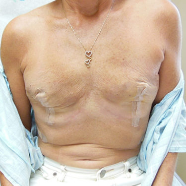 Breast Reconstruction Patient 19 - After 2