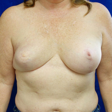 Breast Reconstruction Patient 20 - After 2