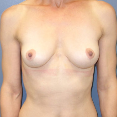 Fat Grafting Patient 01 - Before 1