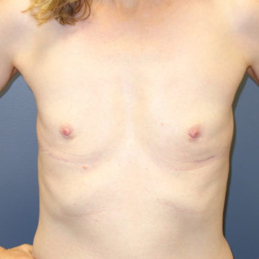 Fat Grafting Patient 02 - Before 1