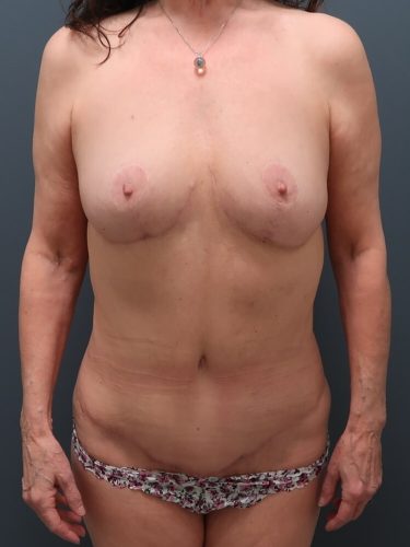 Mommy Makeover Patient 02 - After 1