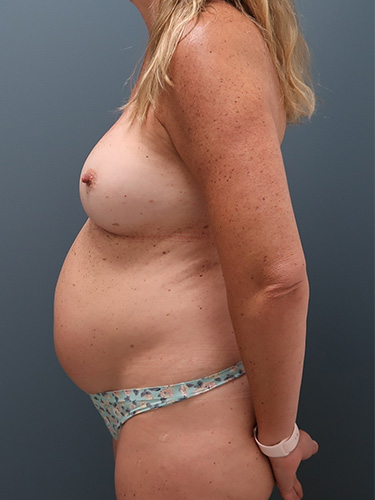 Mommy Makeover Patient 05 - Before 2