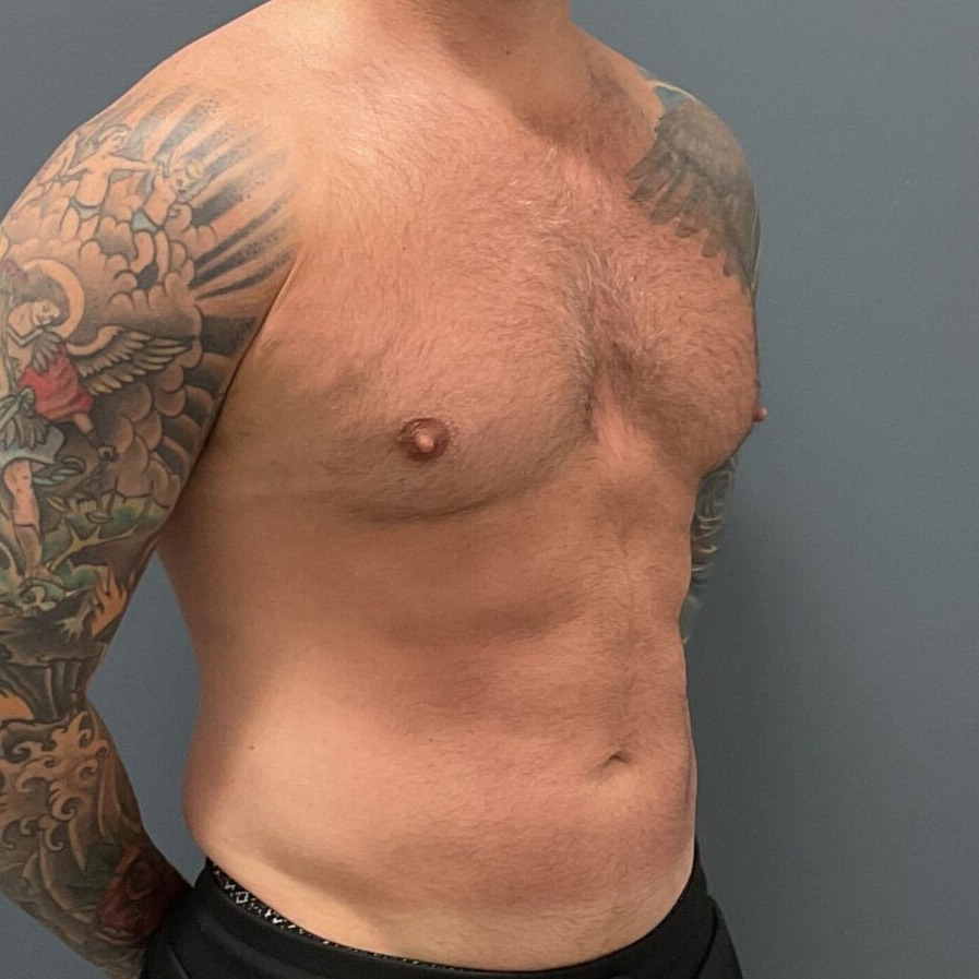 Liposuction-Patient-01 | After Fat Grafting 4