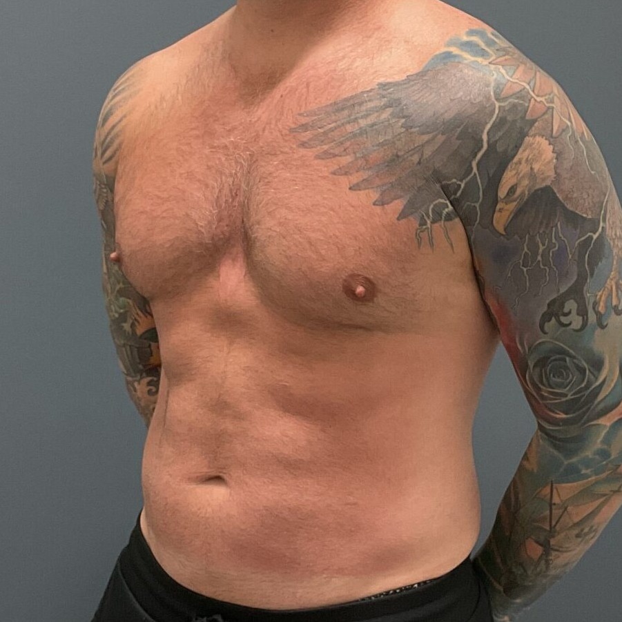 Liposuction-Patient-01 | After Fat Grafting 3