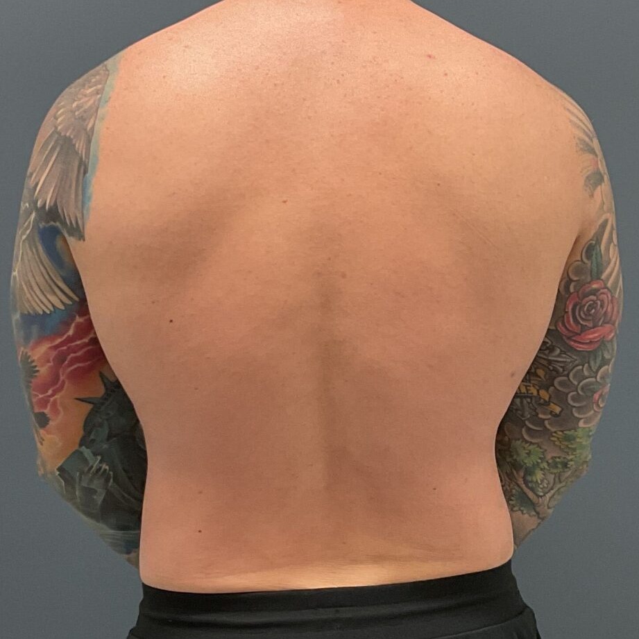 Liposuction-Patient-01 | After Fat Grafting 2