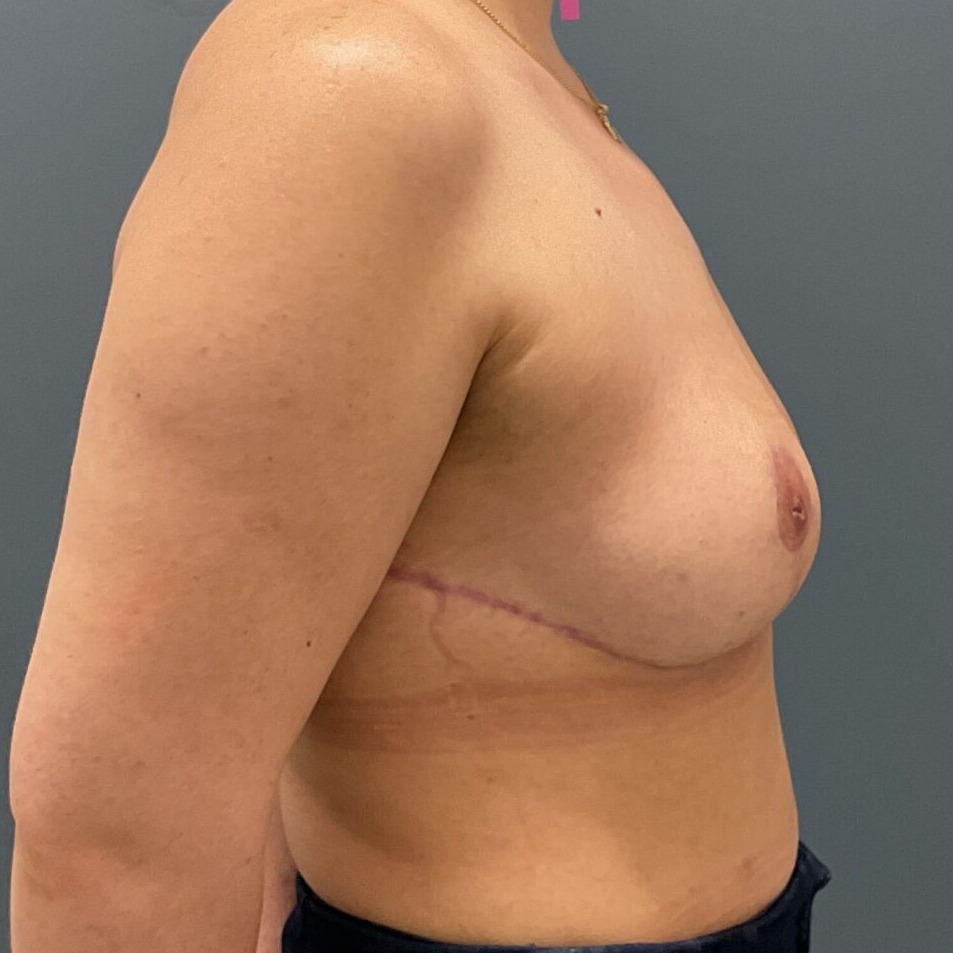 En-Bloc---Lift | After En Bloc + Lift (Mastopexy) 4