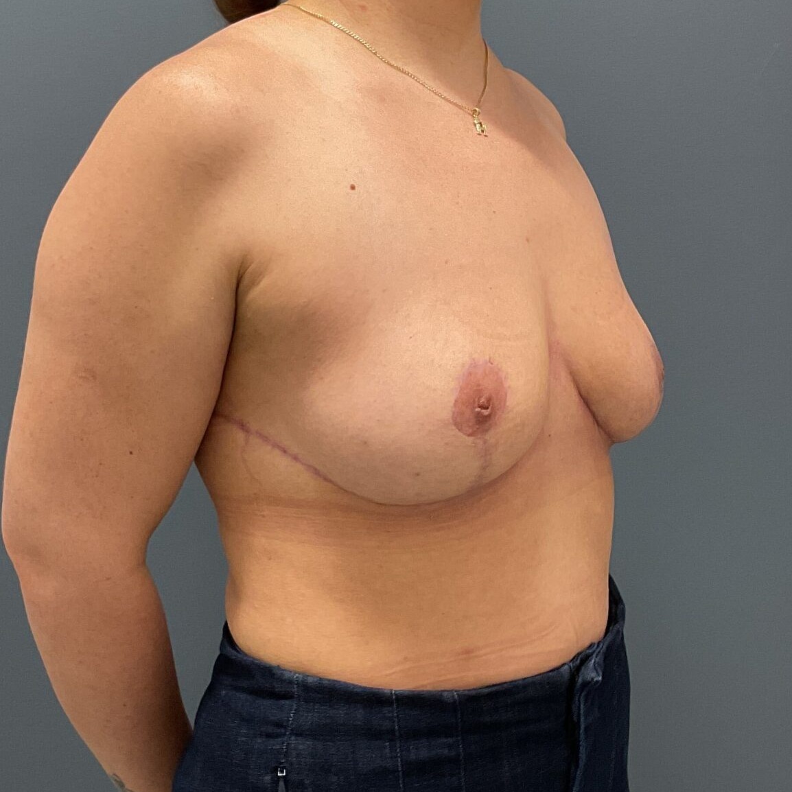 En-Bloc---Lift | After En Bloc + Lift (Mastopexy) 3