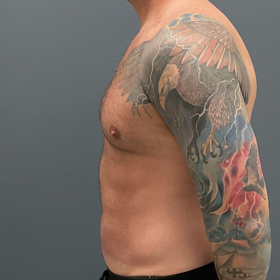 Liposuction-Patient-01 | After Fat Grafting 6