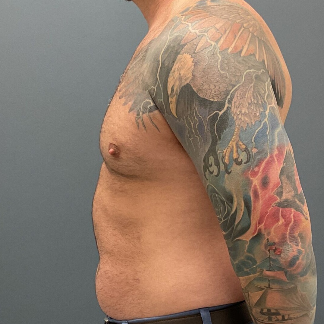 Liposuction-Patient-01 | Before Fat Grafting 6