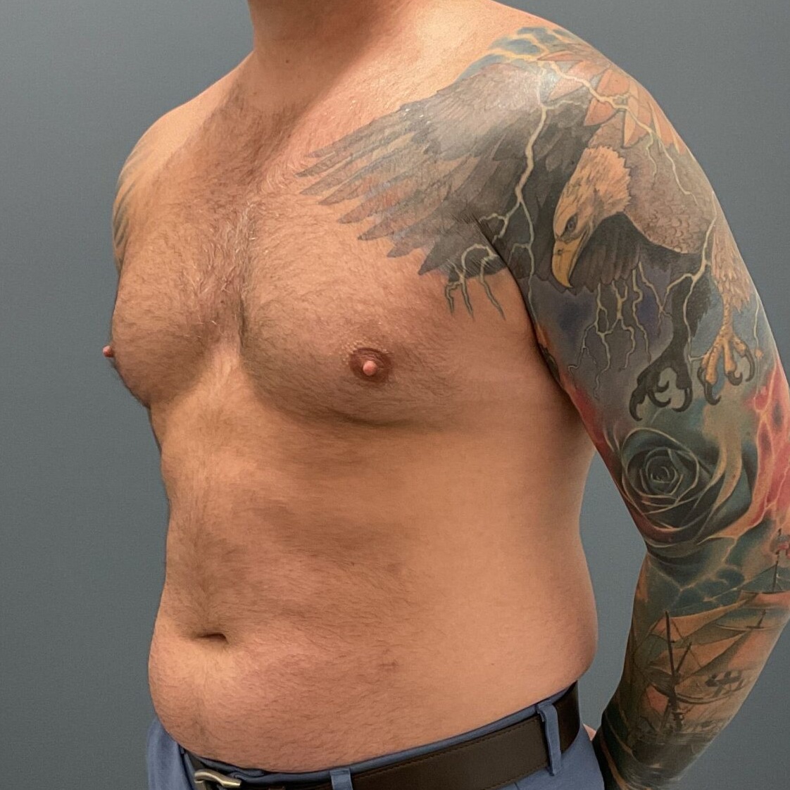 Liposuction-Patient-01 | Before Fat Grafting 3