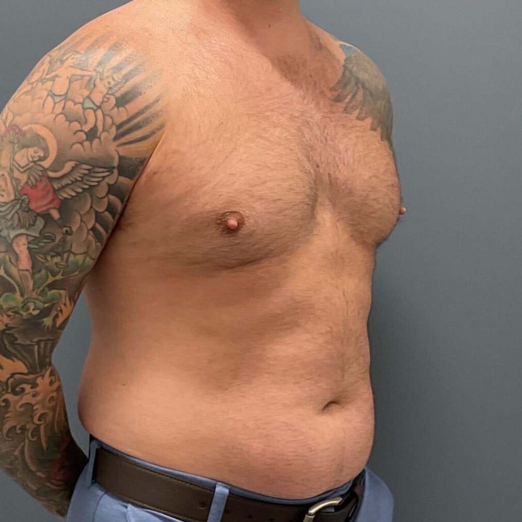 Liposuction-Patient-01 | Before Fat Grafting 4