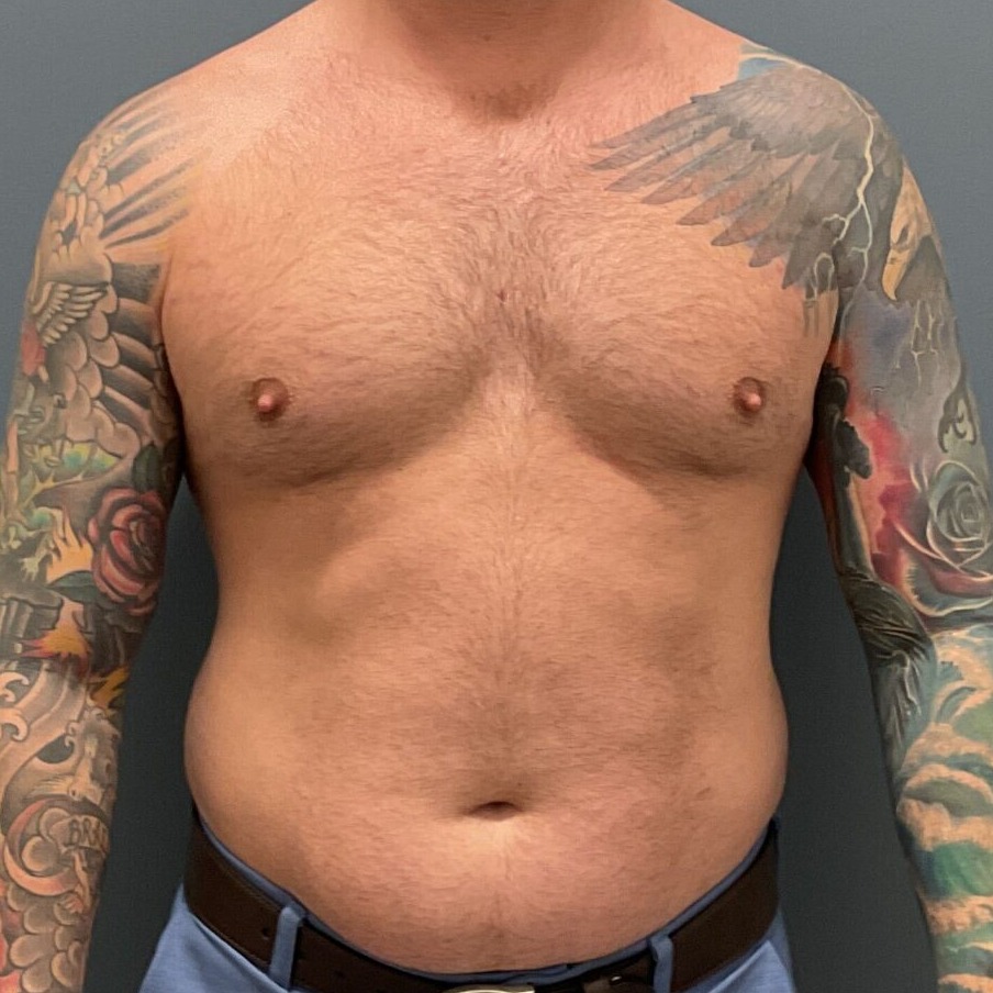 Liposuction-Patient-01 | Before Liposuction