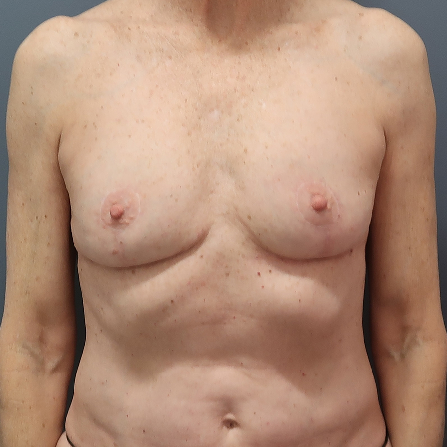 En-bloc---Lift-and-Fat-Grafting-Patient-20 | After Explant