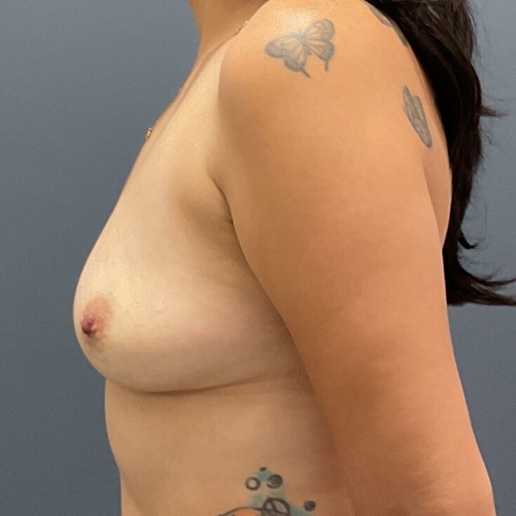 AC--28599-Explant-w--En-Bloc | After En Bloc Only 3