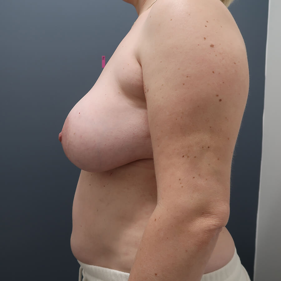 En-bloc---Lift-and-Fat-Grafting-Patient-29 | Before Full Correction Explant Surgery (En Bloc plus Fat Grafting w/ Lift) 6