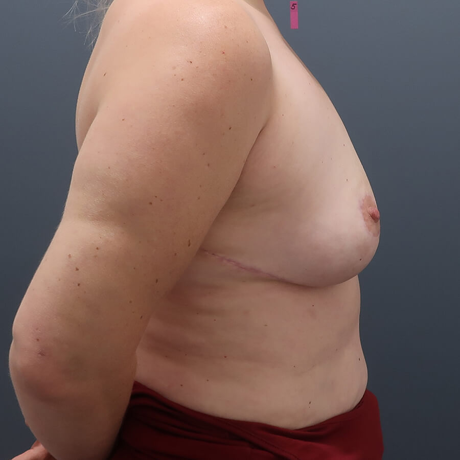 En-bloc---Lift-and-Fat-Grafting-Patient-29 | After Full Correction Explant Surgery (En Bloc plus Fat Grafting w/ Lift) 4