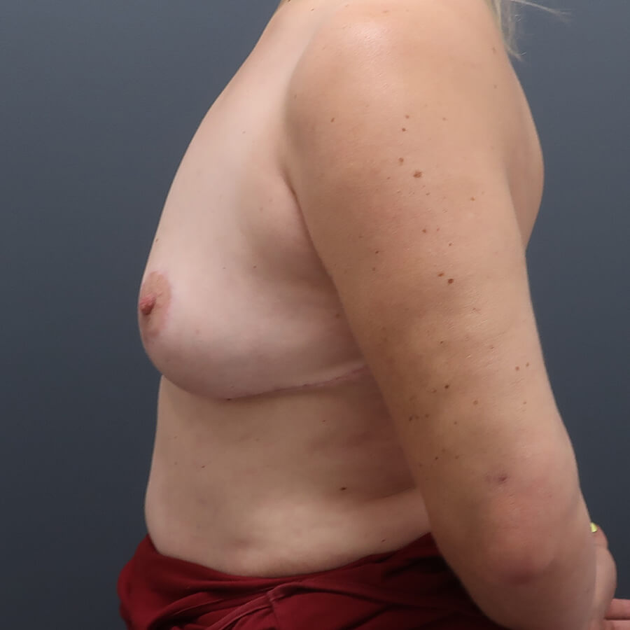 En-bloc---Lift-and-Fat-Grafting-Patient-29 | After Full Correction Explant Surgery (En Bloc plus Fat Grafting w/ Lift) 6