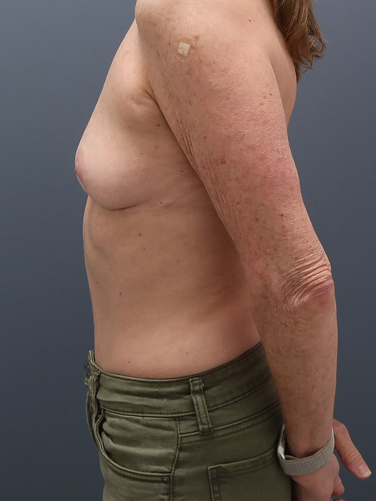 Mommy-Makeover-Patient-11 | After Mommy Makeover 3