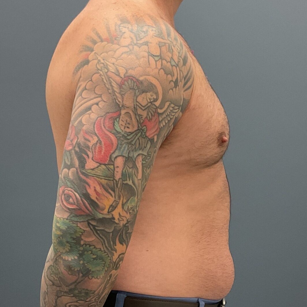 Liposuction-Patient-01 | Before Fat Grafting 5