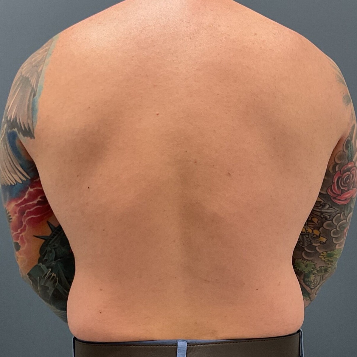 Liposuction-Patient-01 | Before Fat Grafting 2