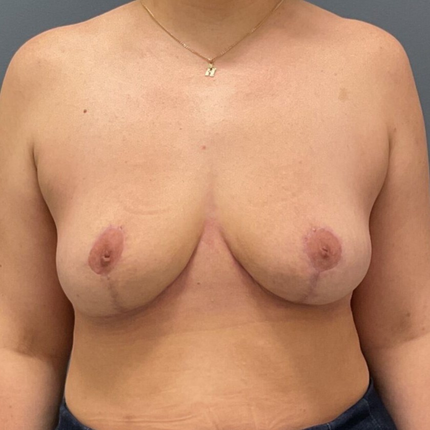 En-Bloc---Lift | After En Bloc + Lift (Mastopexy) 2