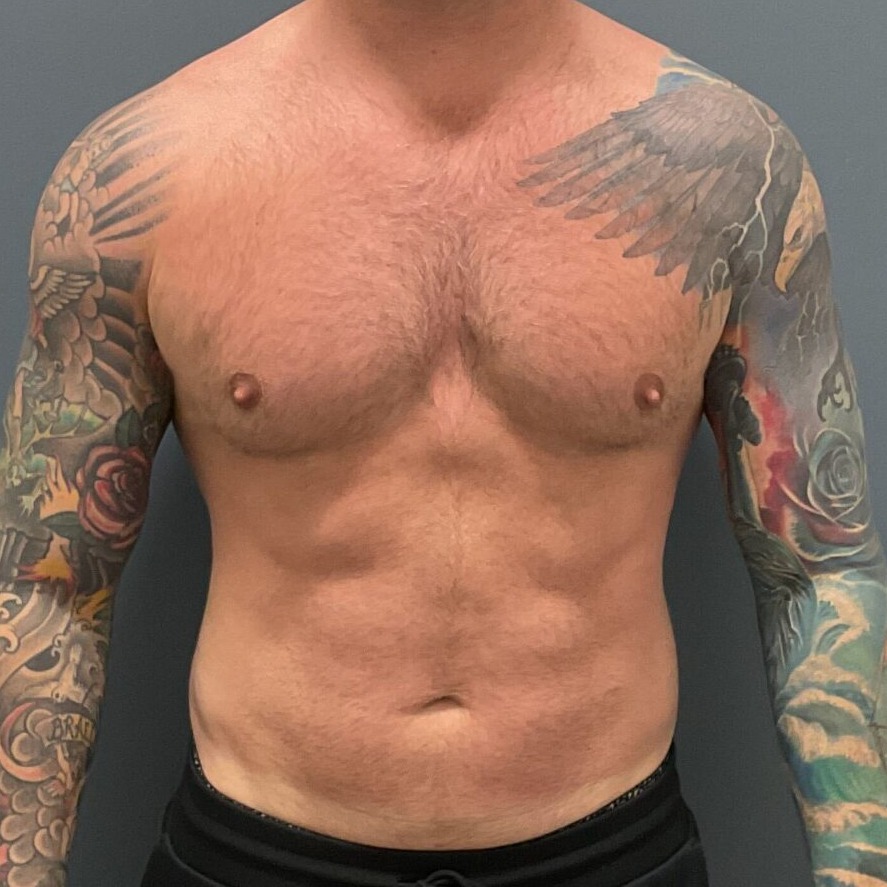 Liposuction-Patient-01 | After Liposuction