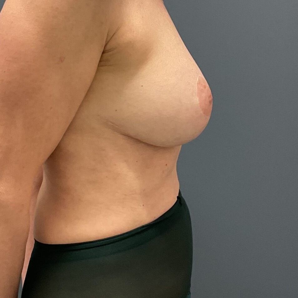 Full-Correction-Explant-Surgery--En-Bloc-plus-Fat-Grafting-w--Lift- | After Full Correction Explant Surgery (En Bloc plus Fat Grafting w/ Lift) 4