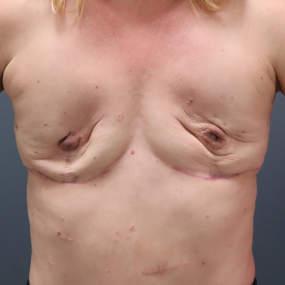 Case--4876 | Before En Bloc + Fat Grafting Only 1