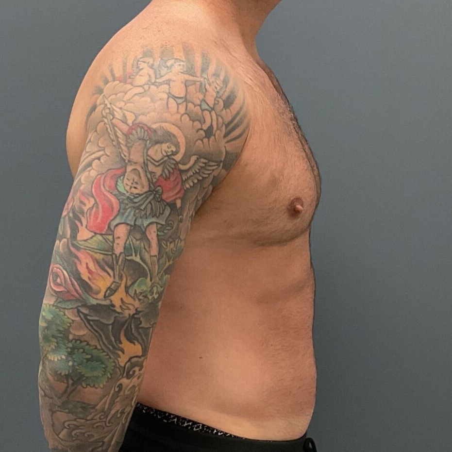 Liposuction-Patient-01 | After Fat Grafting 5