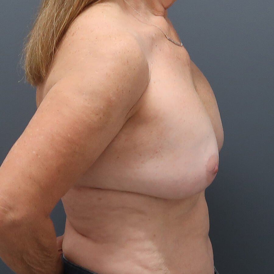 En-bloc---Lift-and-Fat-Grafting-Patient-21 | Before Full Correction Explant Surgery (En Bloc plus Fat Grafting w/ Lift) 4