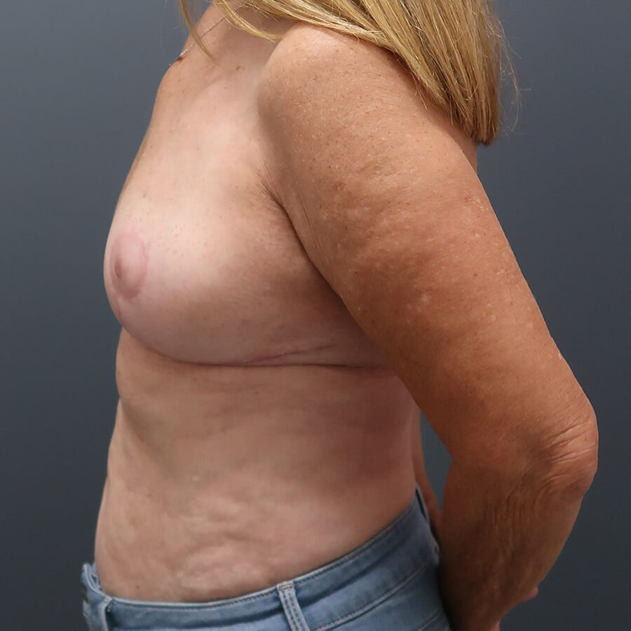 En-bloc---Lift-and-Fat-Grafting-Patient-21 | After Full Correction Explant Surgery (En Bloc plus Fat Grafting w/ Lift) 5