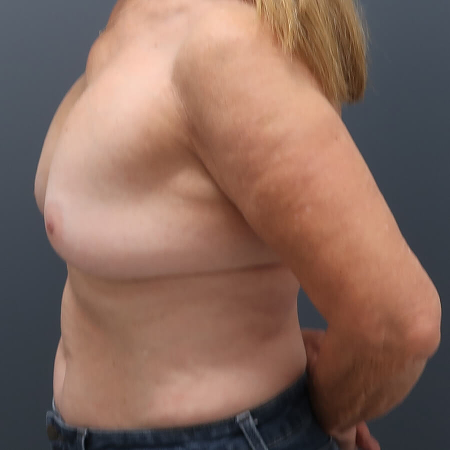 En-bloc---Lift-and-Fat-Grafting-Patient-21 | Before Full Correction Explant Surgery (En Bloc plus Fat Grafting w/ Lift) 5