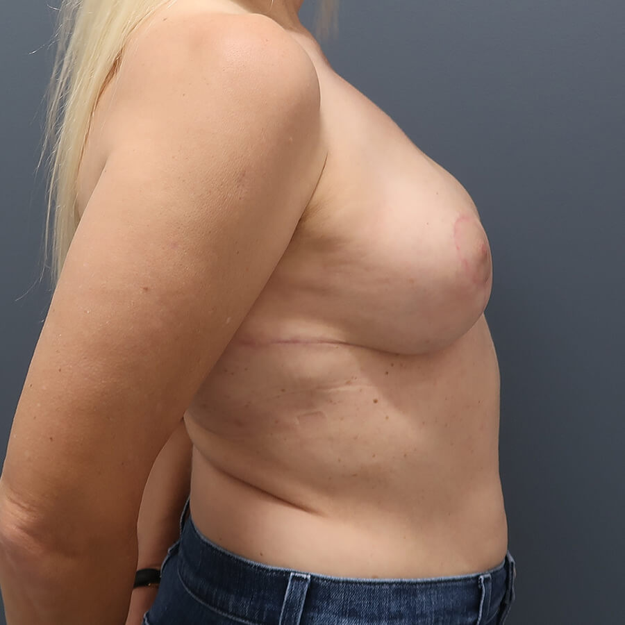 En-bloc---Lift-and-Fat-Grafting-Patient-24 | After Full Correction Explant Surgery (En Bloc plus Fat Grafting w/ Lift) 4