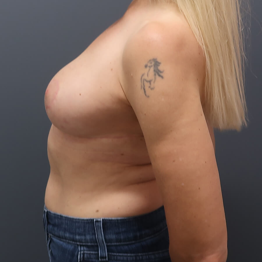 En-bloc---Lift-and-Fat-Grafting-Patient-24 | After Full Correction Explant Surgery (En Bloc plus Fat Grafting w/ Lift) 6