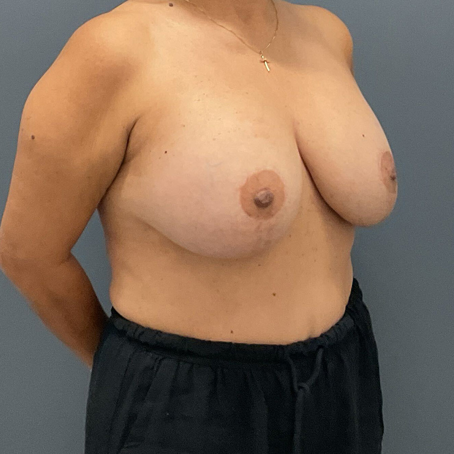 Case--6249 | Before En Bloc + Lift (Mastopexy) 2